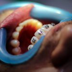 Turismo dentale, l'ortodonzia in Croazia funziona?