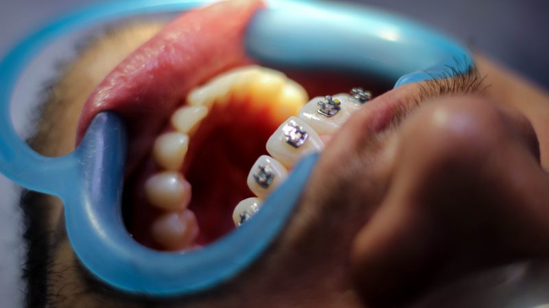 Turismo dentale, l’ortodonzia in Croazia funziona?